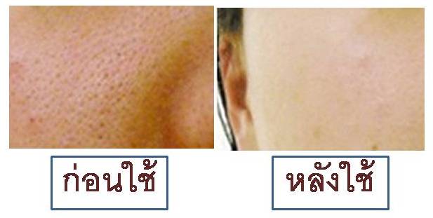 รูขุมขนกว้าง-หน้ามัน-กระชับรูขุมขนด้วย-miracle-drops-มิราเคิ