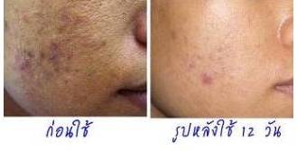 แผลเป็น-จุดด่างดำ-จากสิว-หายเกลี้ยงภายใน-2-สัปดาห์ด้วย-super