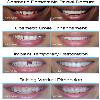snap-on-smile-แก้ไขฟันห่าง-ฟันไม่สวย-ฟันสั้น-ฟันเหลือง-holly