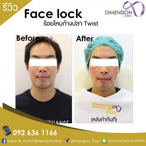 ร้อยไหมก้างปลา-ทองหล่อ-dimension-clinic-ดีจริง-ขั้นตอนร้อยไห