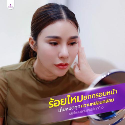 ยกกระชับด้วยการร้อยไหม