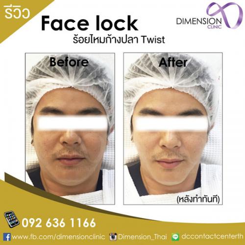 ร้อยไหมที่ไหนดี-ร้อยไหมปรับหน้าเรียว-รีวิวร้อยไหมdimensioncl