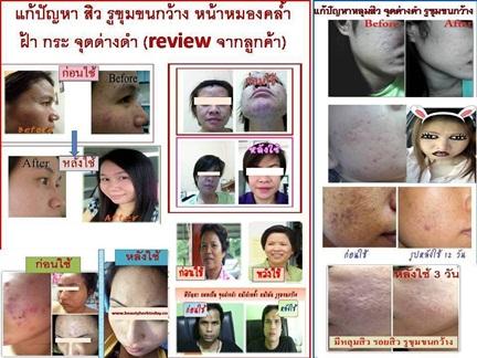 เซตปราบสิว-สิวอุดตัน-สิวผด-สิวเสี้ยน-สิวอักเสบ-เห็นผลดีที่สุ