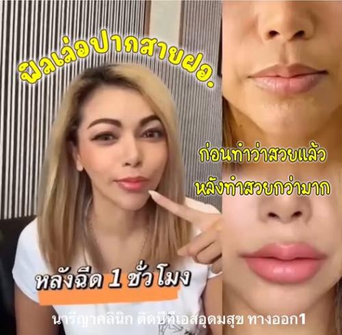 ฟิลเลอร์ปาก-neuramis