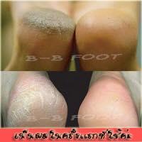 b-b-foot-ขายน้ำยาดีท็อกซ์-amp;แก้ปัญหาส้นเท้าแตก-เห็นผลใน-30